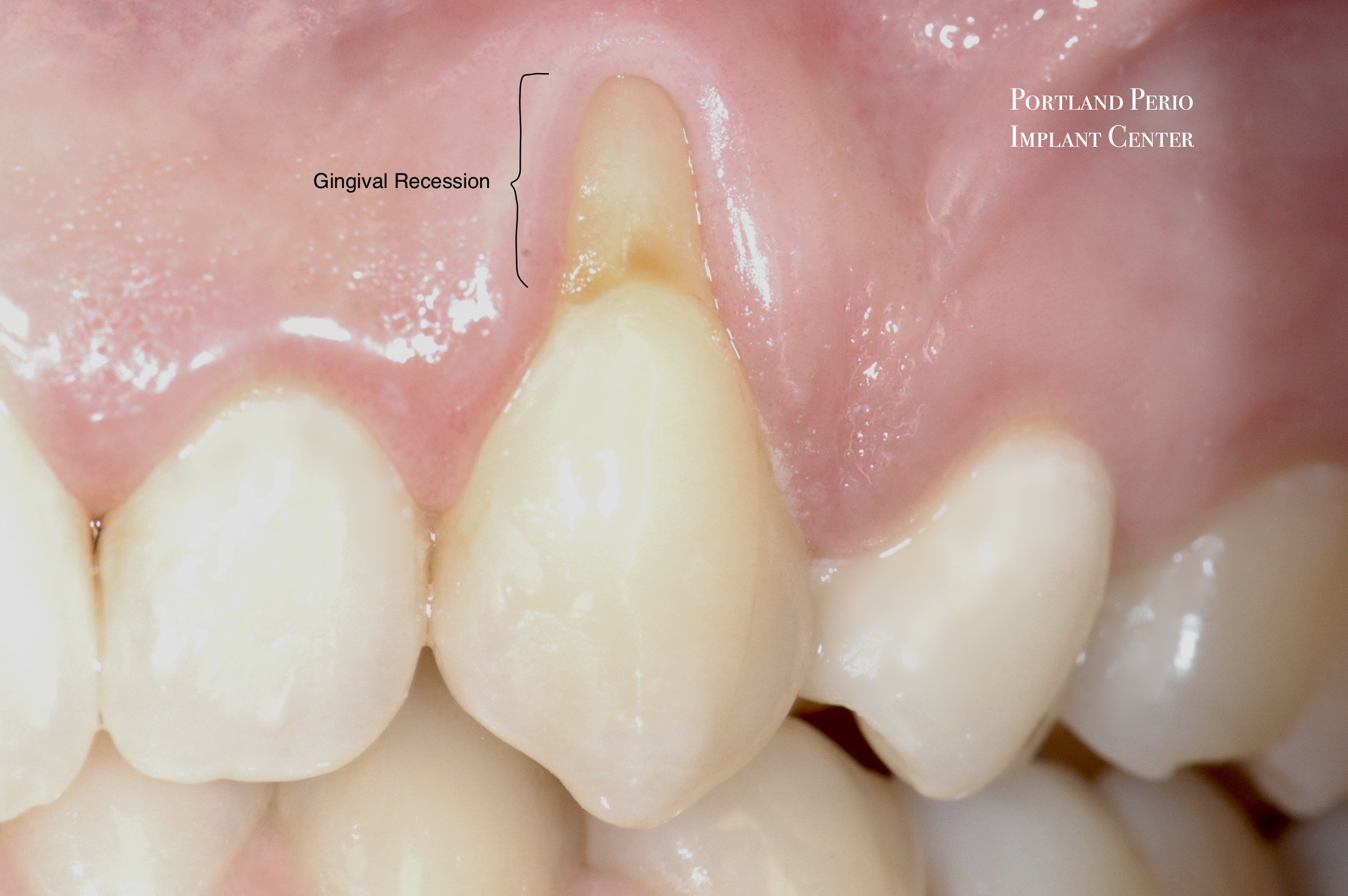 How do you know if a gum graft failed