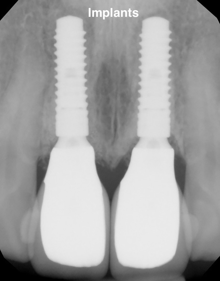 Radiograph after treatment for dental imlants and crowns on two front teeth.