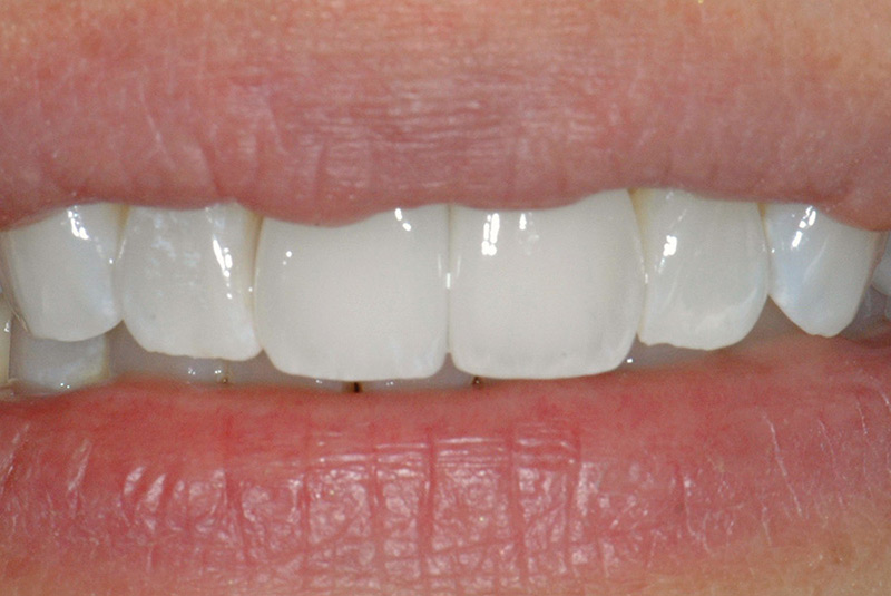 Final restorations with two dental imlants and zirconia crowns on two front teeth.