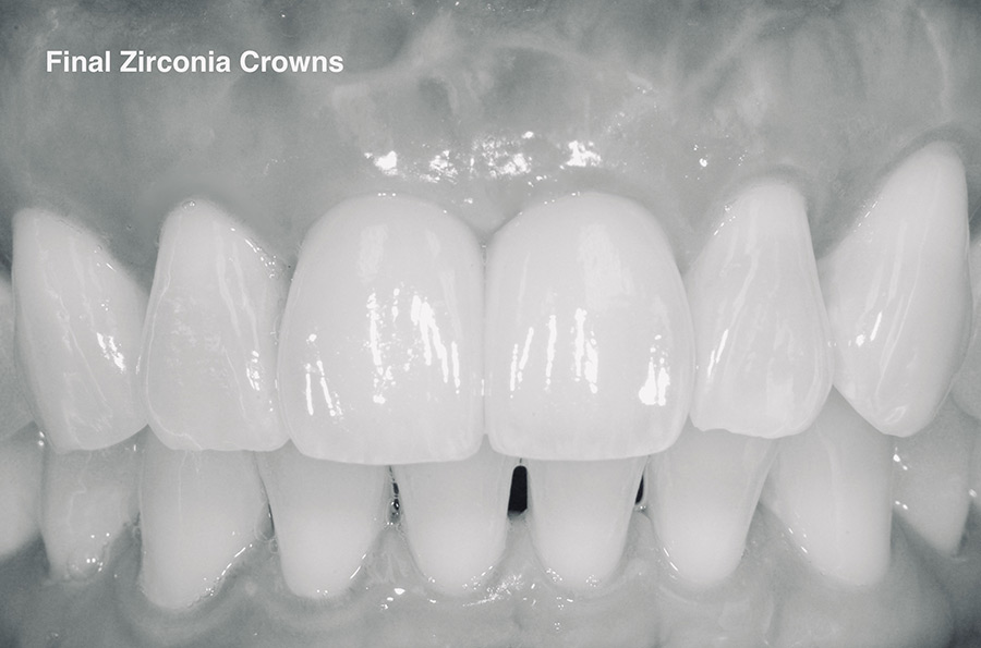 Final restorations after dental implant treatment and zirconia crowns