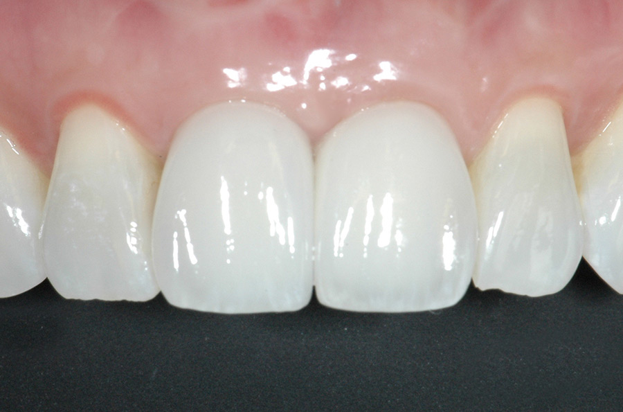 Final restorations after dental implants and zirconia crowns