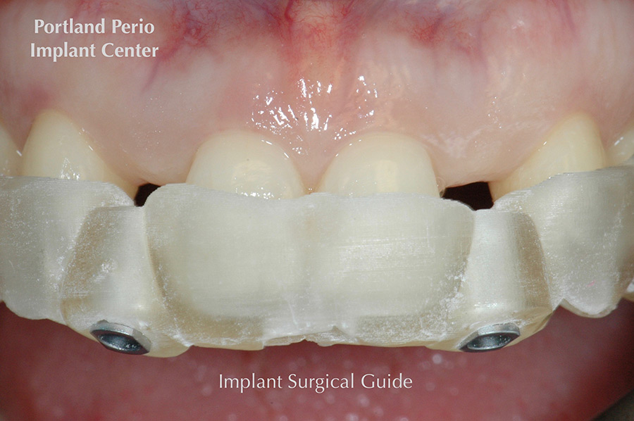 Guided surgery at Portland Perio Implant Center