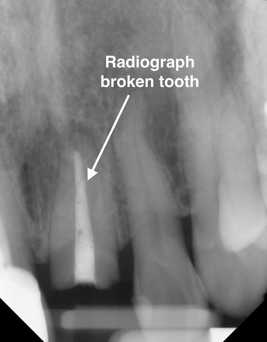 Radiograph of patient's broken front tooth.