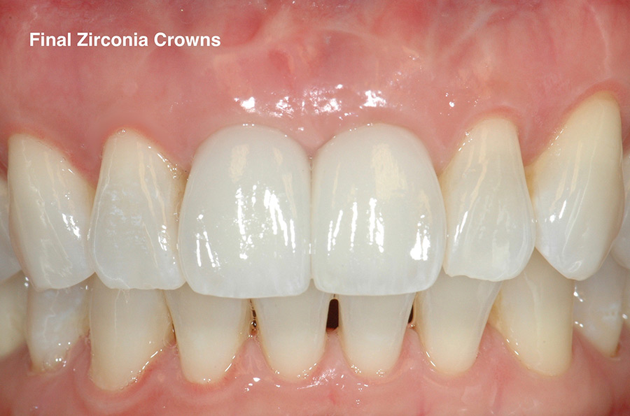 Final zirconia crowns installed in patient's mouth.
