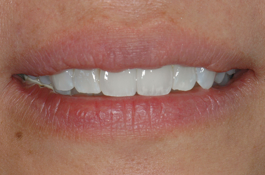 Patient smiling after successful dental implant treatment on two front teeth.