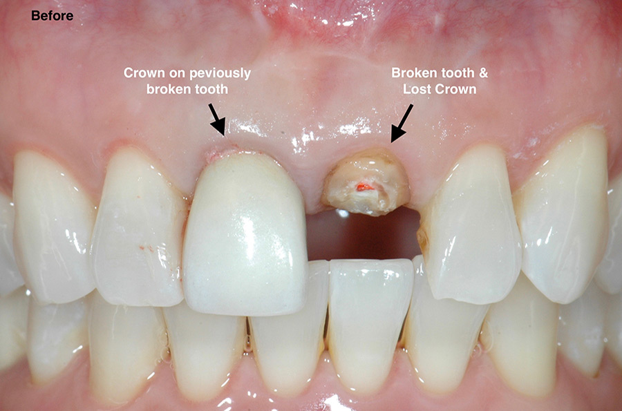 Broken front tooth before dental implant.
