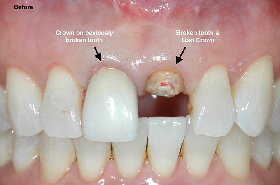 dental implants front teeth