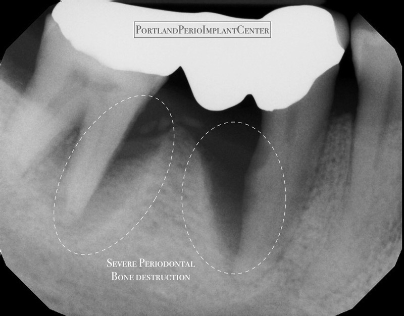 Xray showing severe periodontal bone loss