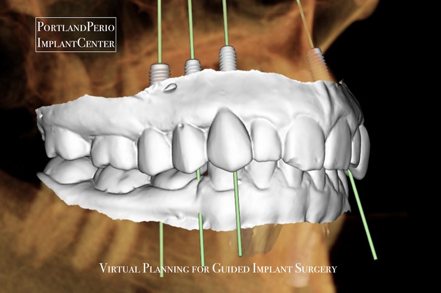 Dental implants to replace congenitally missing teeth for a patient of Portland Perio Implant Center