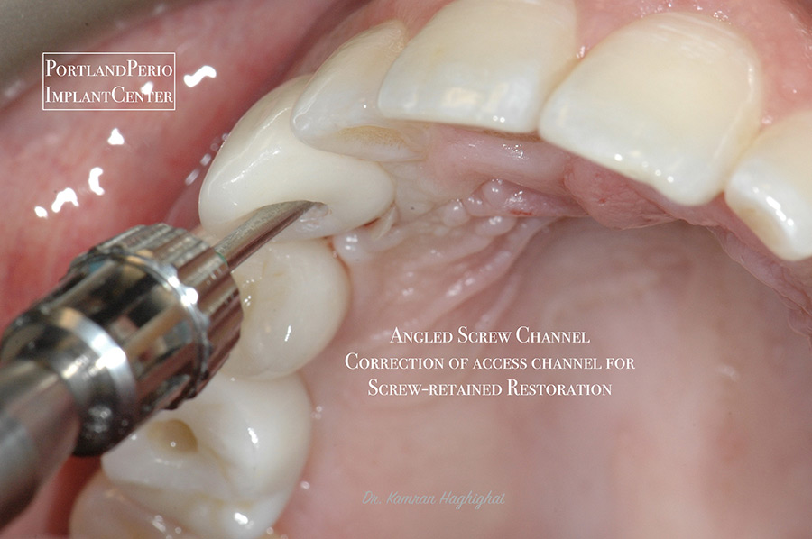 Dental implants to replace congenitally missing teeth for a patient of Portland Perio Implant Center