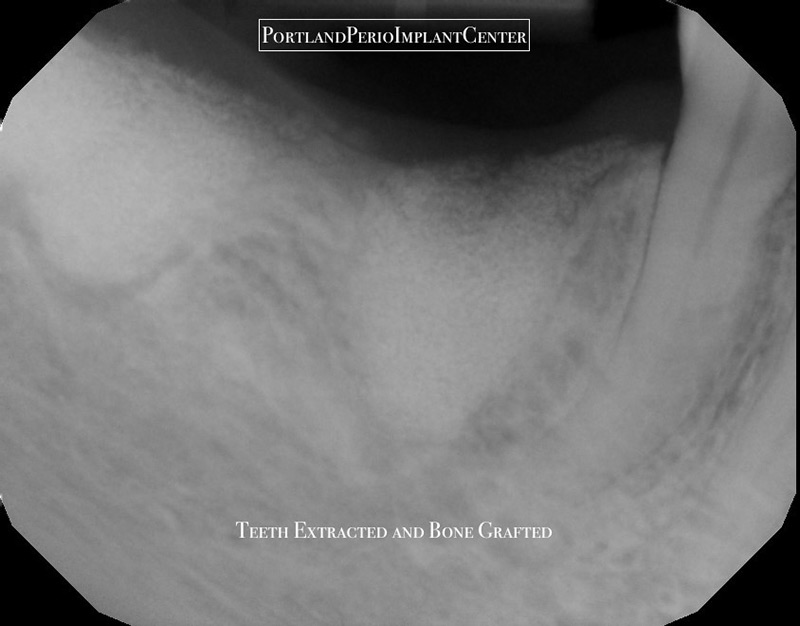 Xray showing teeth extracted and bone graft.