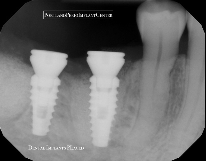 Xray showing after dental implants have been placed.