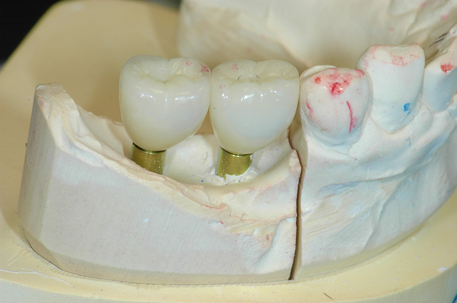 During treatment for severe periodontal bone loss with dental implants