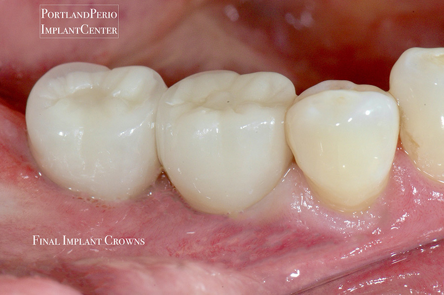 Final crowns after treatment for severe periodontal bone loss at Portland Perio Implant Center