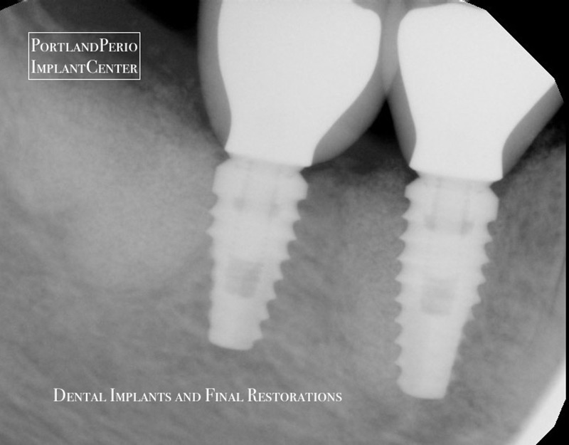 Zray of final crowns after treatment for severe periodontal bone loss at Portland Perio Implant Center