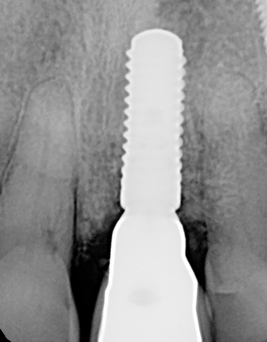 Radiograph of final implant crown patient at Portland Perio Implant Center