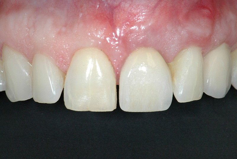 Front tooth restoration using allograft bone ring technique at Portland Perio Implant Center