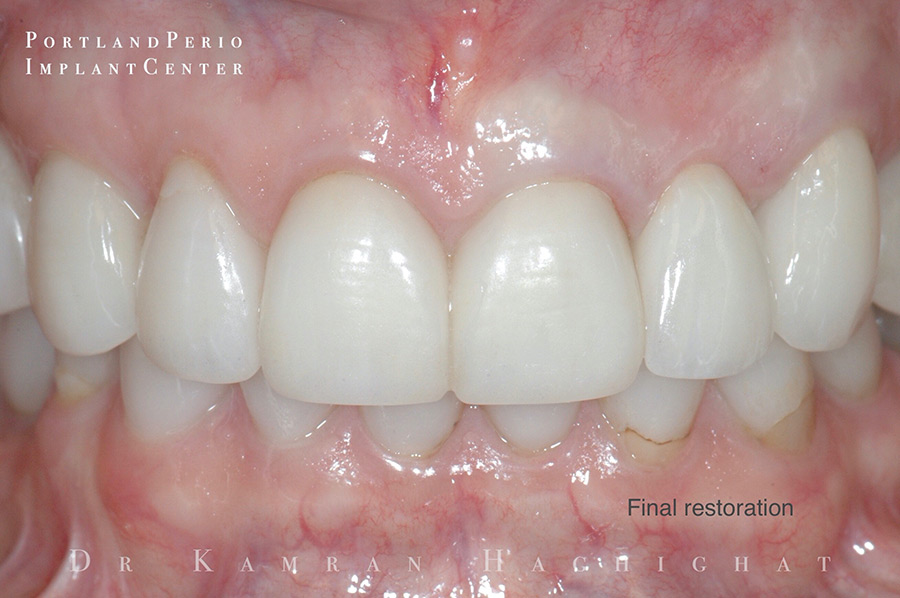 Final restoration of a patient's tooth.