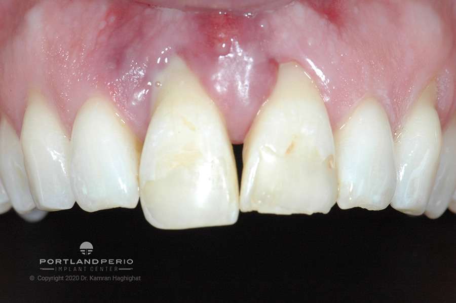 View of front teeth with advanced periodontal disease.
