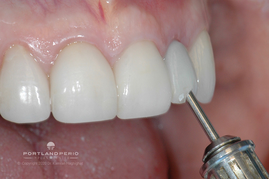 Angled access to temporary tooth