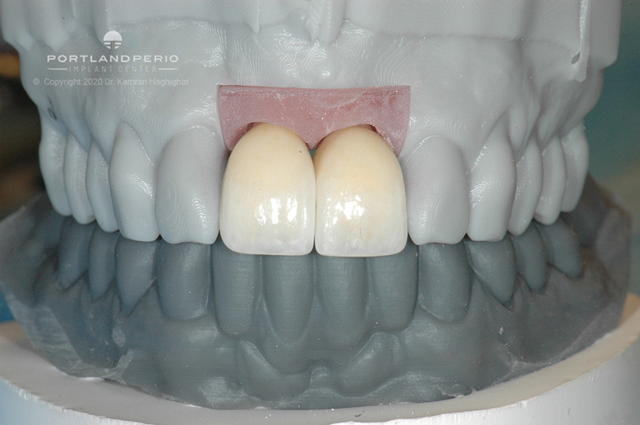 Final crowns before installation to patient.