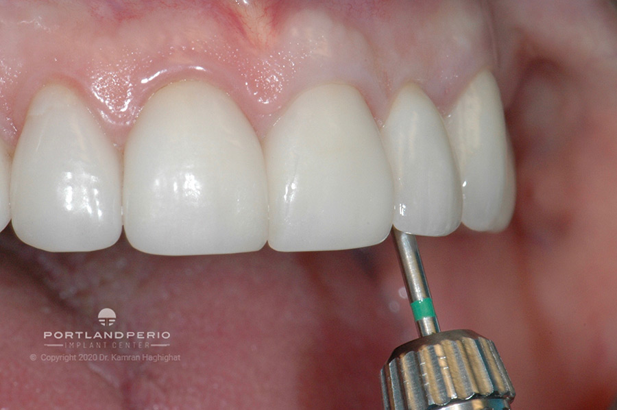 Angled access to new restored tooth