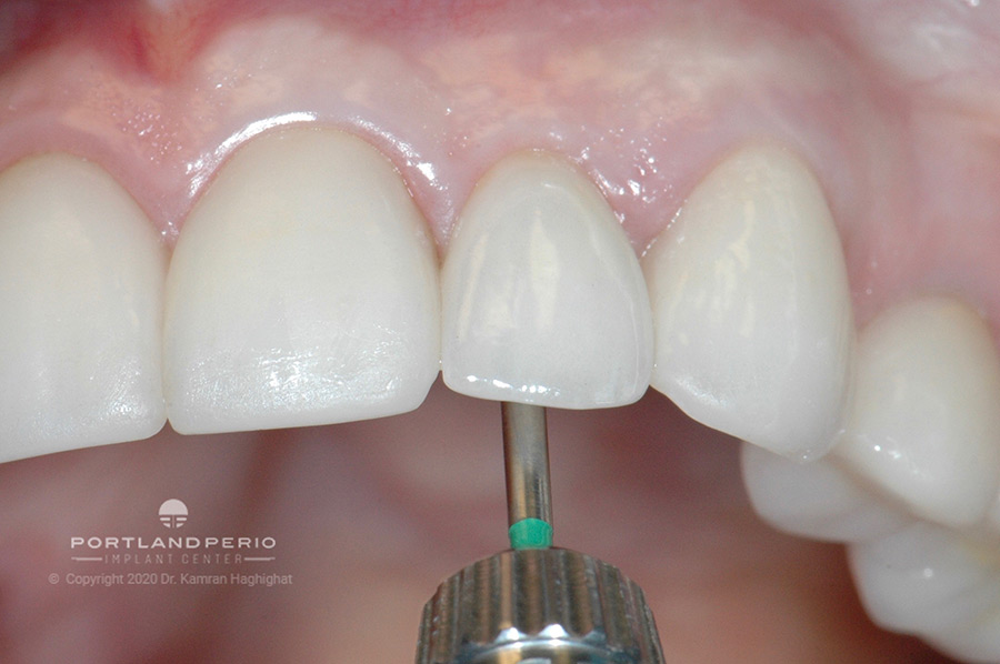 Angled access to new restored tooth