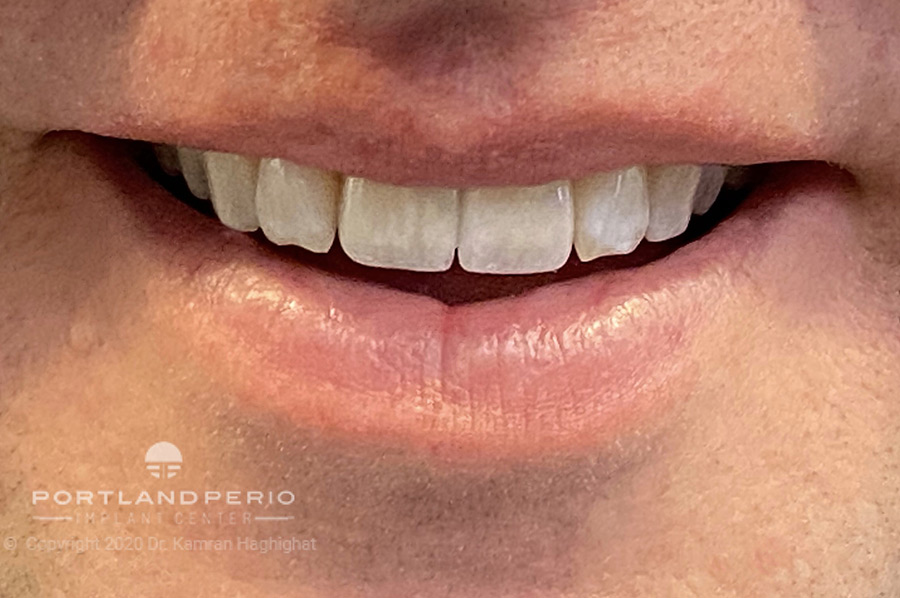 Patient after two dental implants and final crowns.