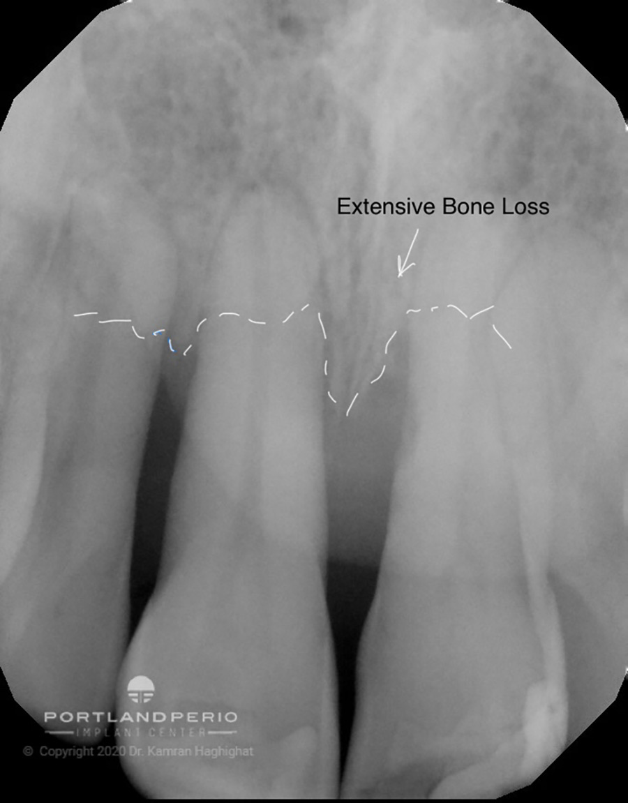 Xray showing bone loss in the two front teeth.