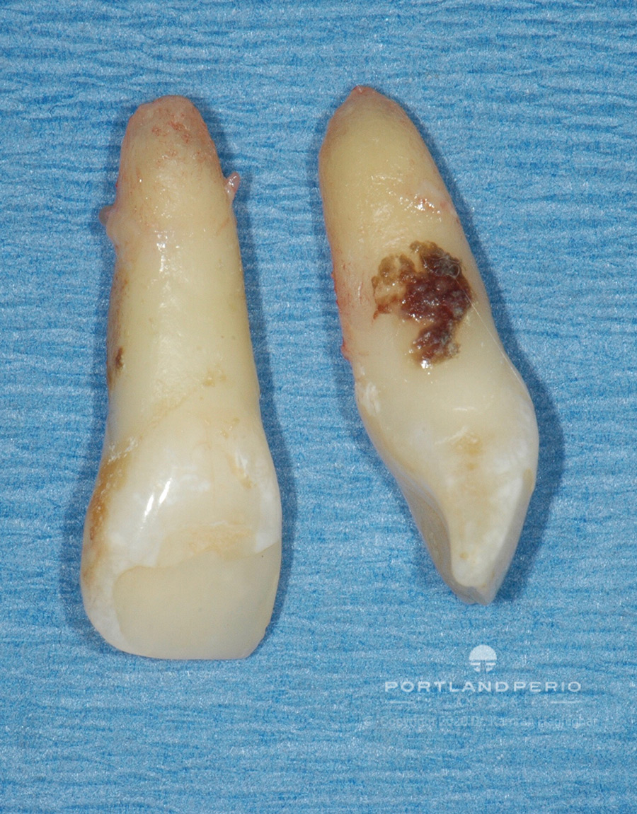 Extracted teeth of patient.