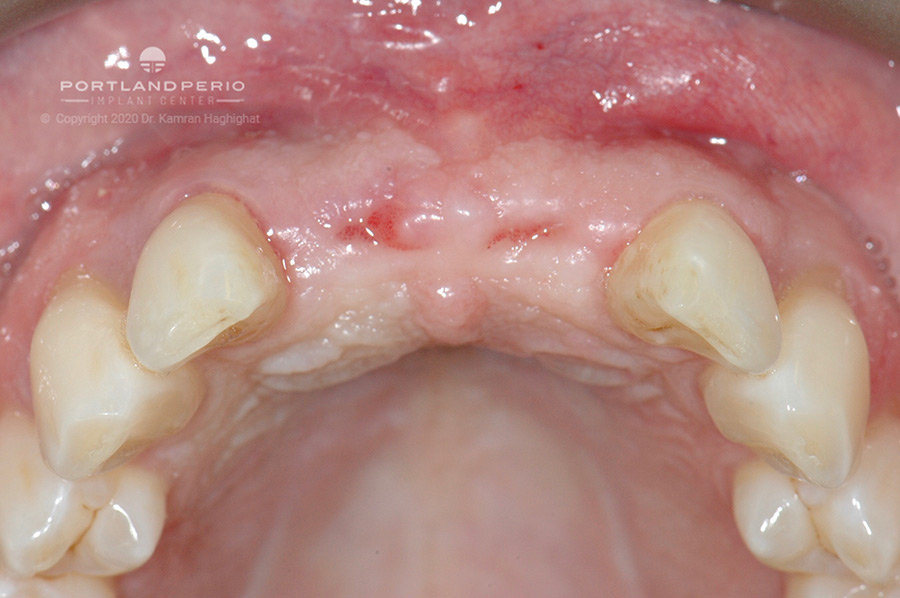 Healed tissue after extraction of two front teeth.