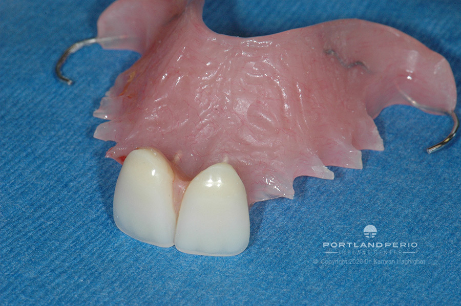 Removable appliance for two front extracted front teeth.