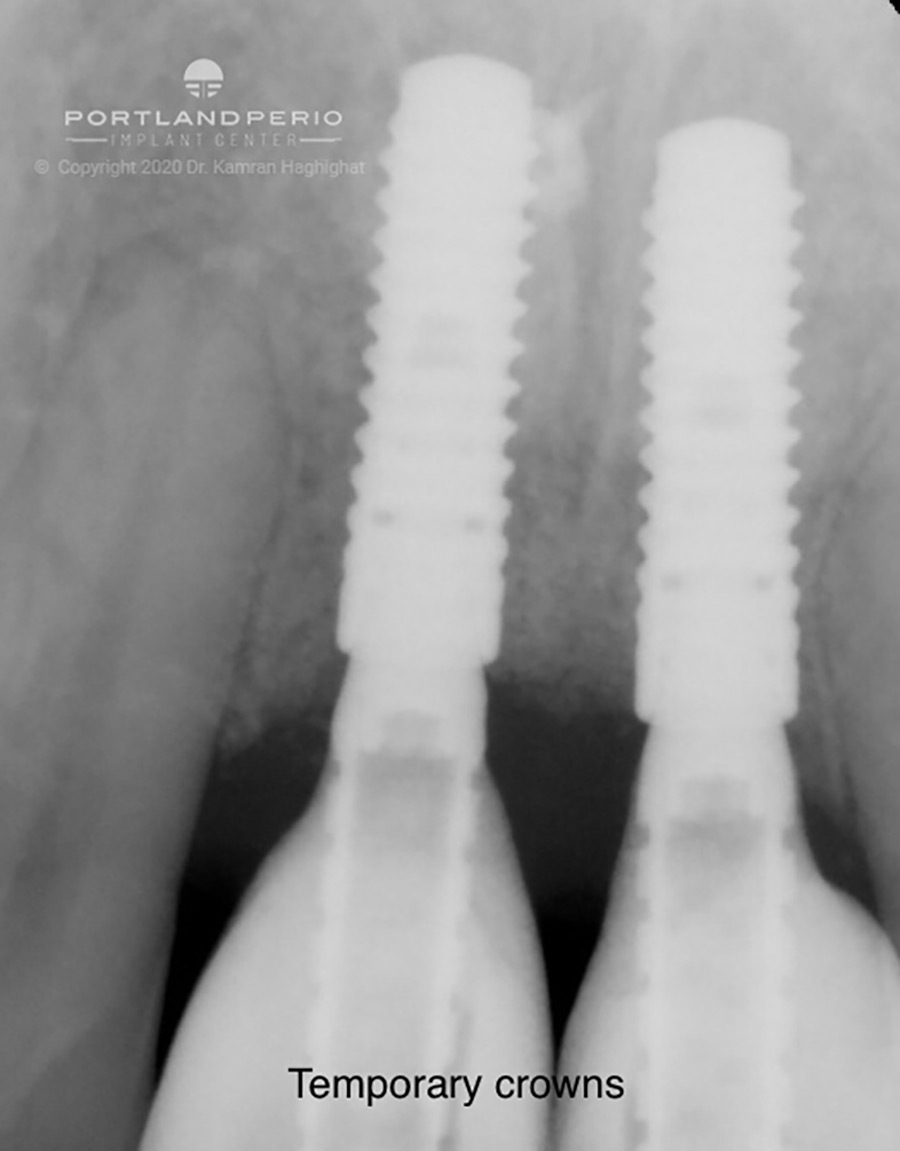 Xray of temporary crowns.