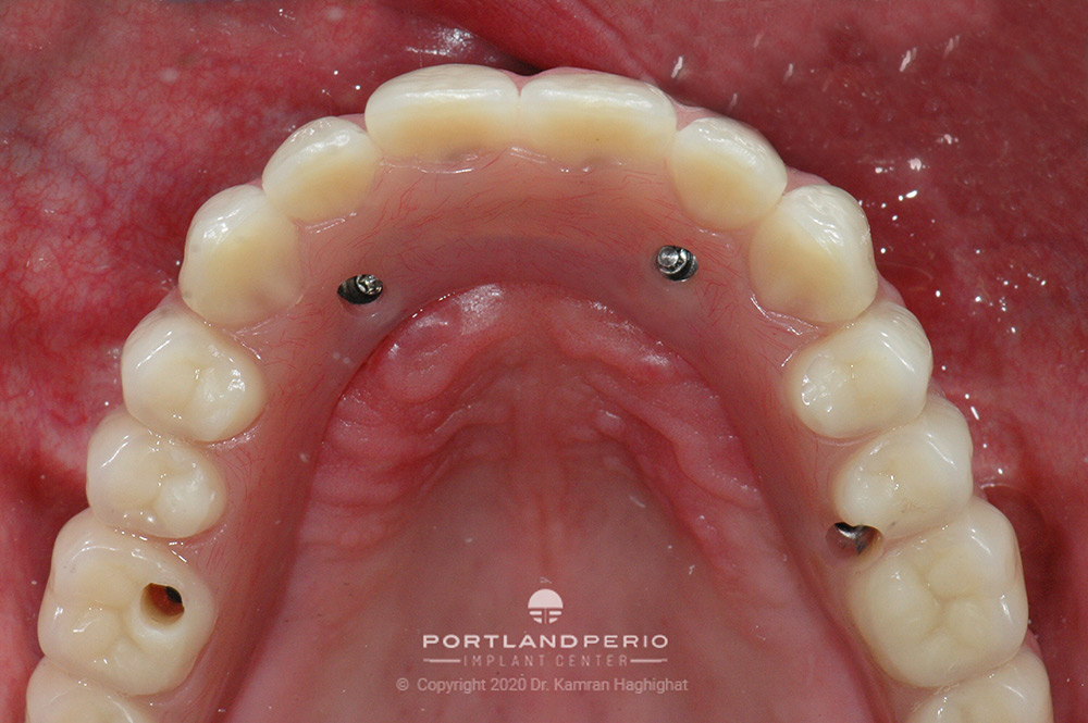 New teeth for a dental implant patient.