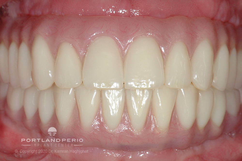 New teeth for a dental implant patient.
