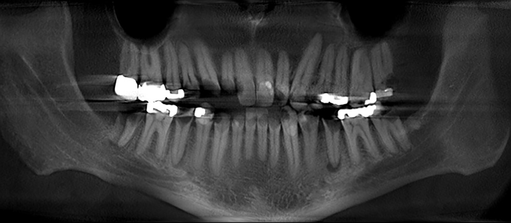 xray of patient mouth before treatment.