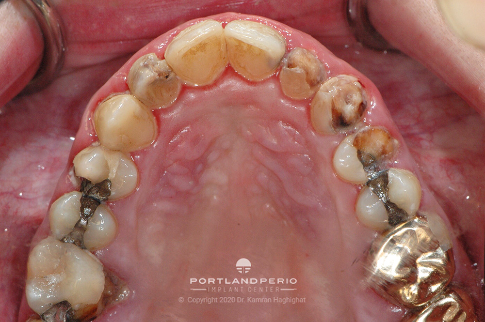 Patient teeth and gums before treatment.