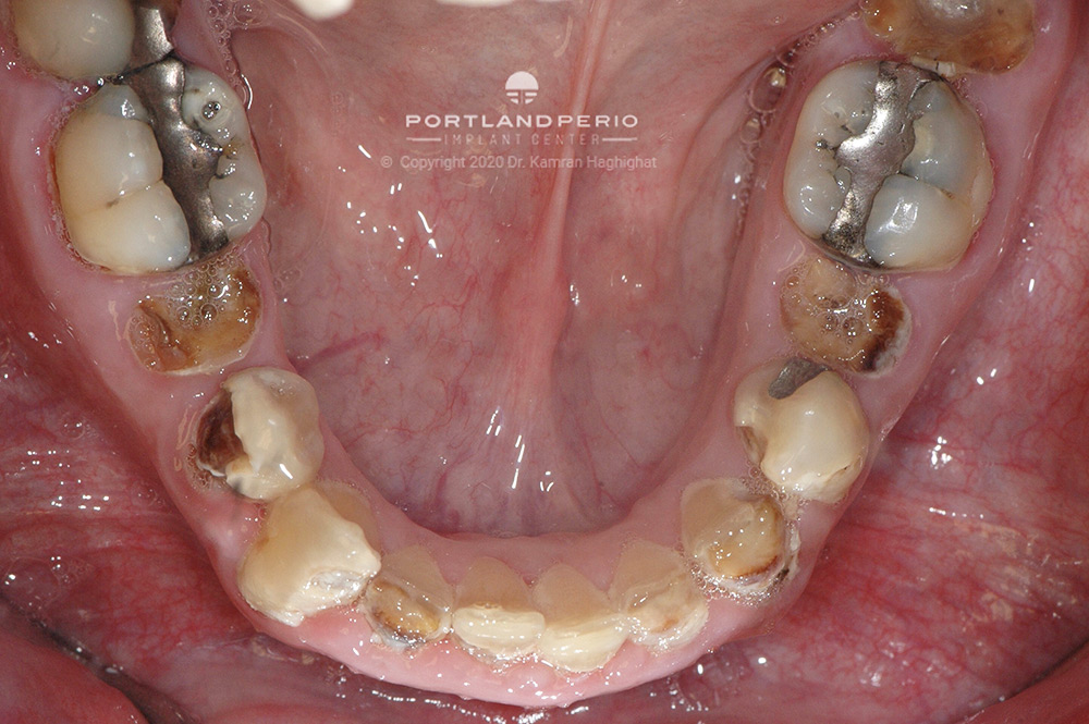 Patient teeth and gums before treatment.