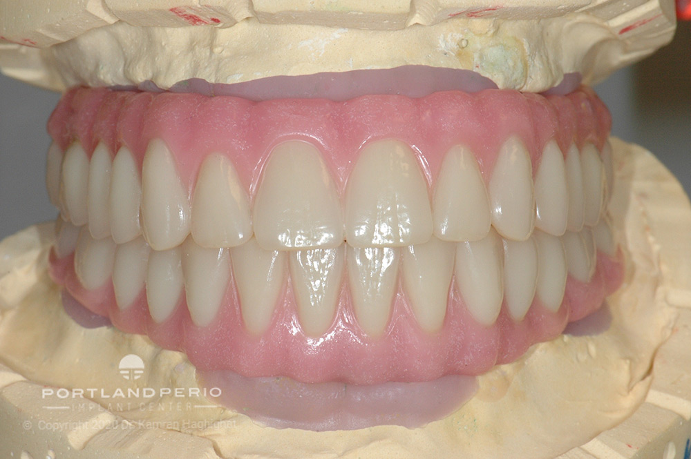 New teeth for a dental patient.