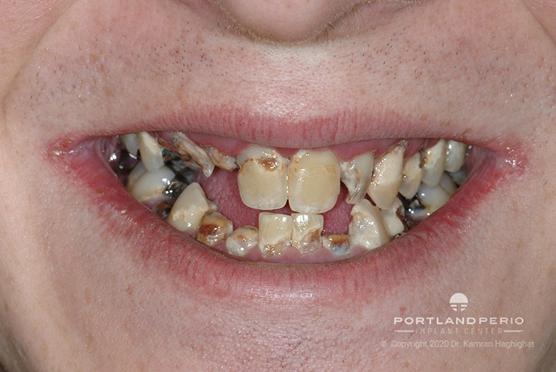 Patient before all-on-4 dental implants