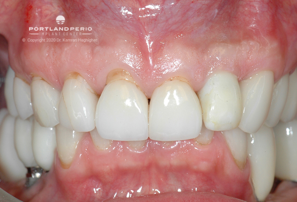 Before esthetic crown lengthening with new full mouth rehabilitation