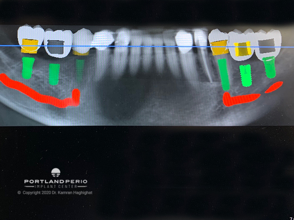 Dental digital implant workflow