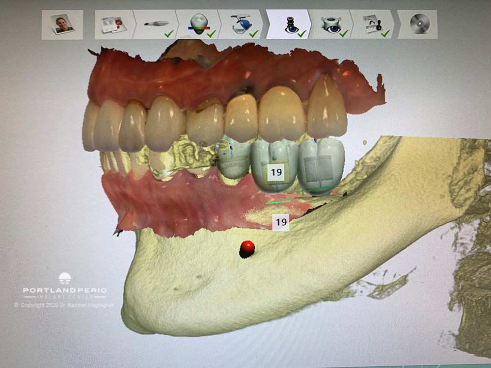 Dental digital implant workflow at Portland Perio Implant Center
