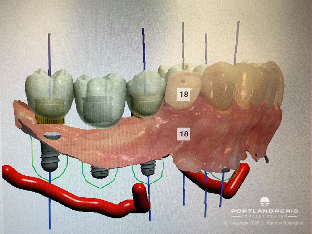 Dental digital implant workflow at Portland Perio Implant Center