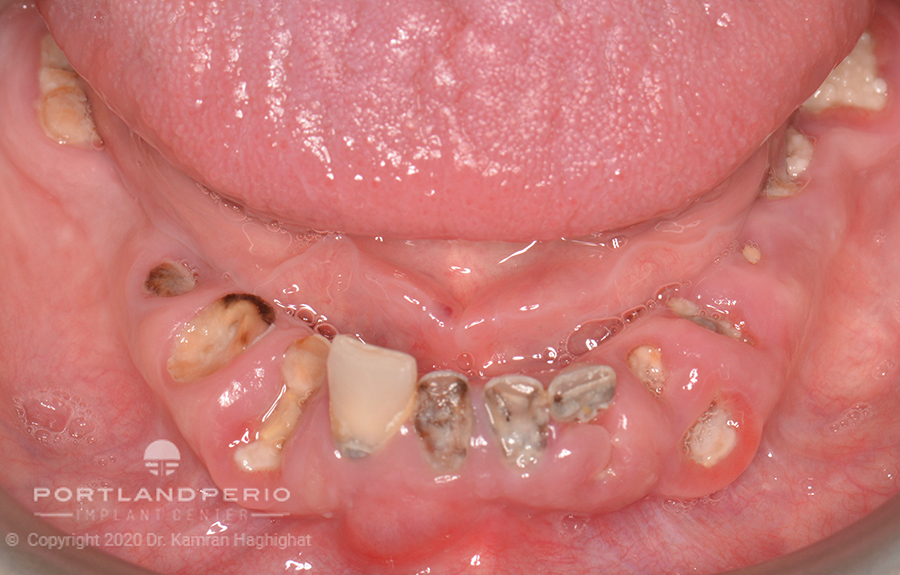 Ami lower jaw before dental implant treatment