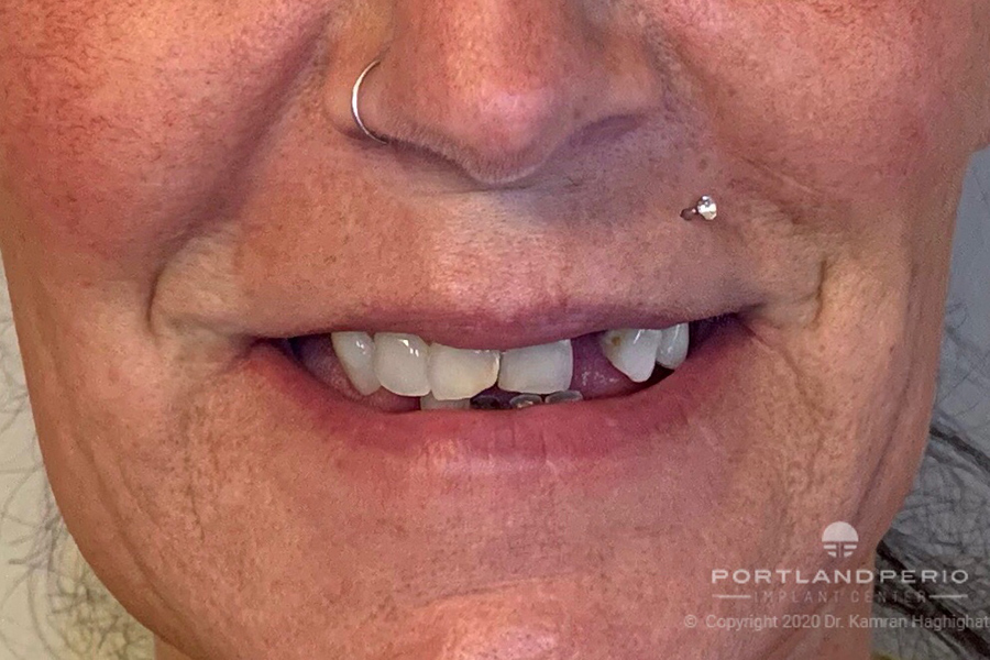 Ami before all-on-4 dental implant treatment