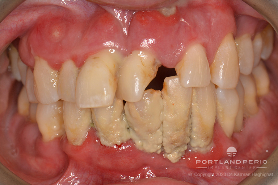 Upper and lower arch of patient before All on Four dental implant treatment.