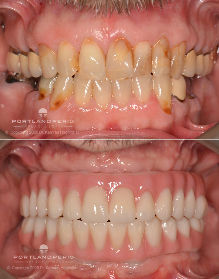 Before and after all on four dental implant treatment.