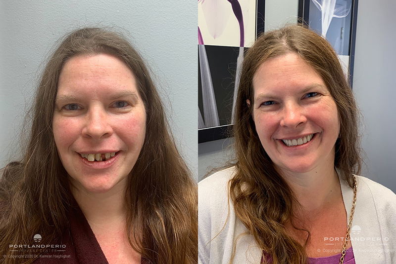 Lindsey before and after dental implants.
