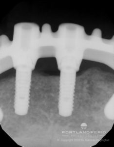 Xrays of all on four dental implants.